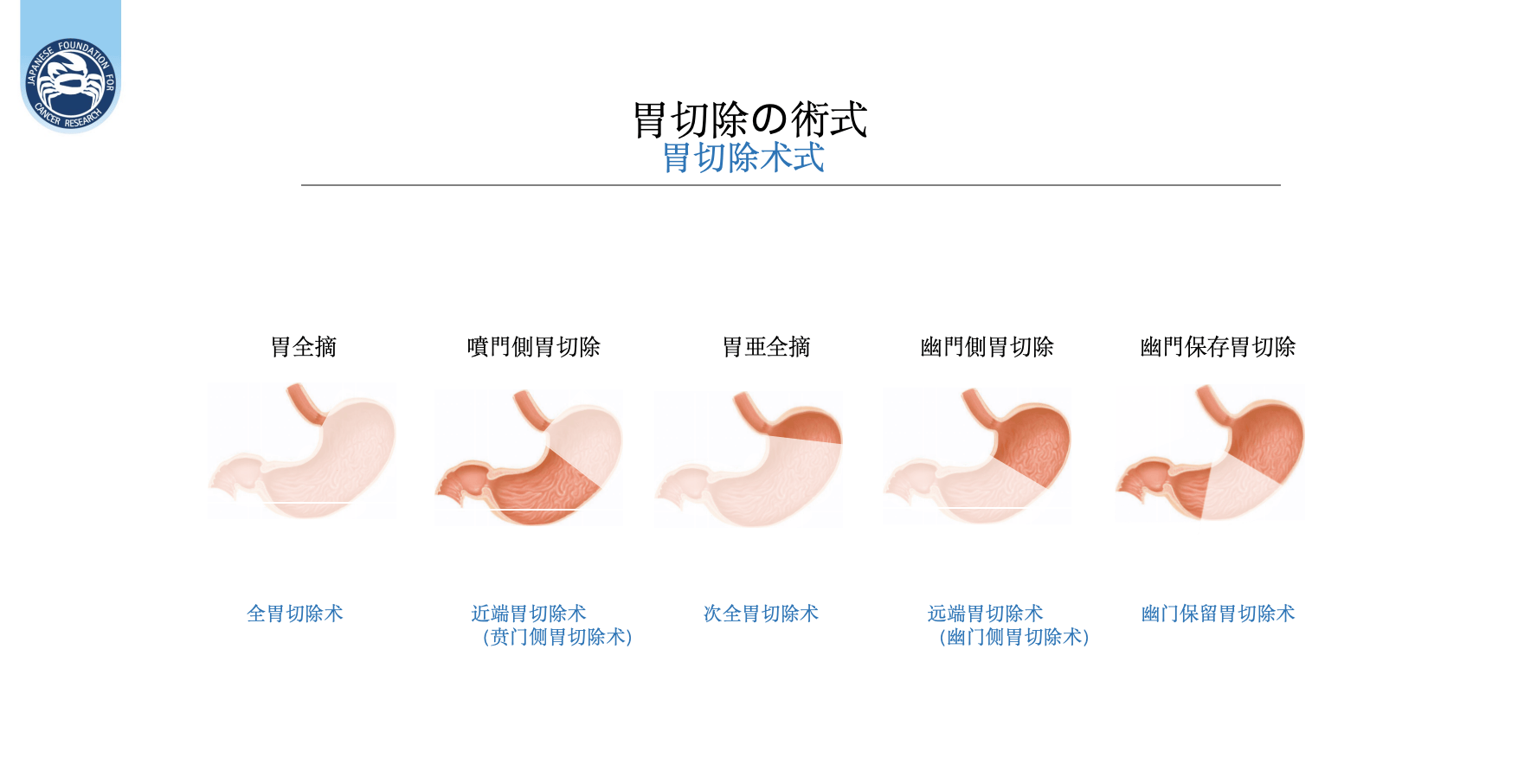 专访日本胃癌“神之手”：“全民除菌”是防癌关键第一步